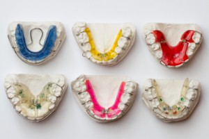 Kieferorthopädie Zahnspangen