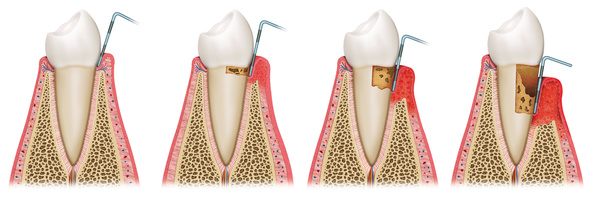 Parodontitisbehandlung