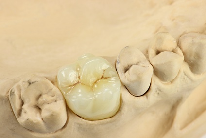 Zahnarztpraxis Baatz - Krone